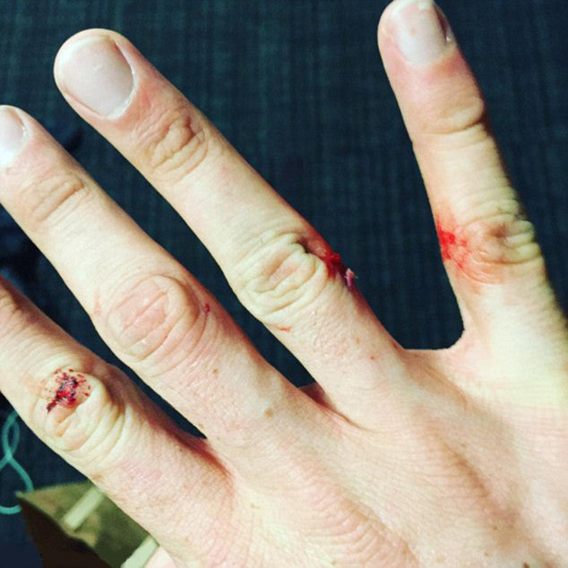 5 Tips to Help Prevent Hand Injuries